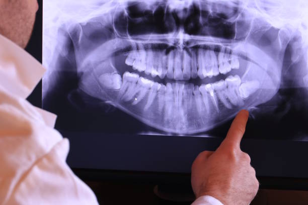 Best Knocked-Out Tooth (Avulsed Tooth) Treatment in San Dimas, CA