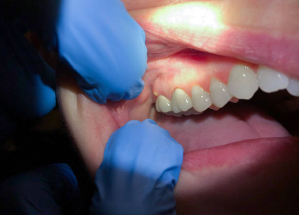 Best Emergency Denture Repair in San Dimas, CA